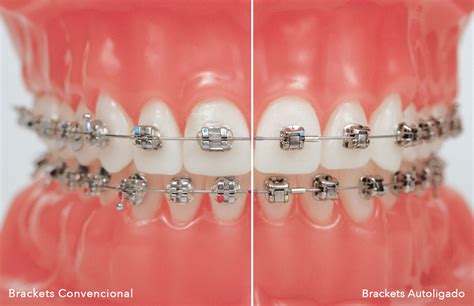 brackets de autoligados metalicos